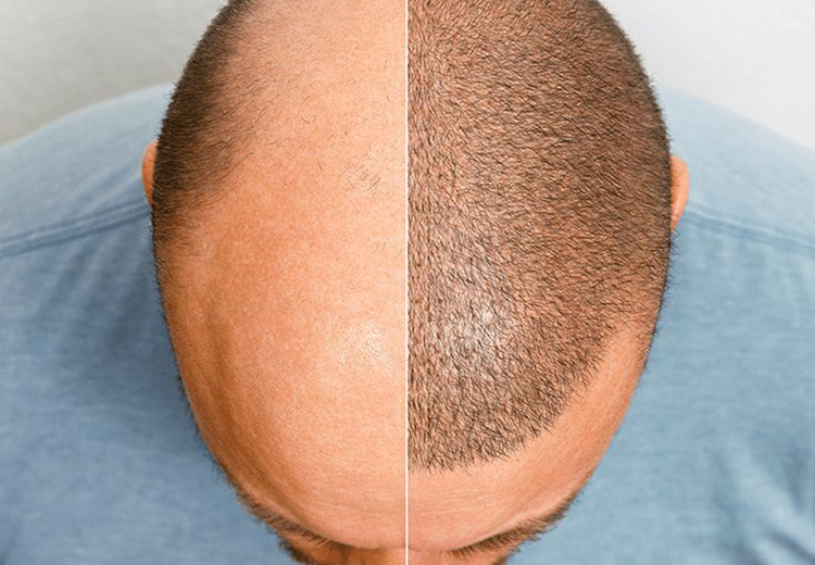 Մազերի փոխպատվաստում